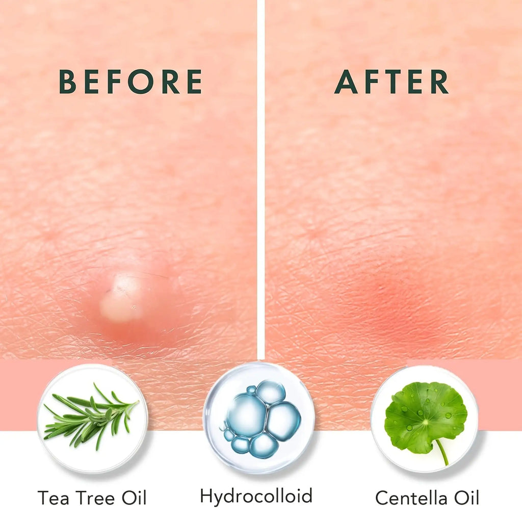 200/400pcs Hydrocolloid Zit Patches with Tea Tree Oil, Effective Acne Treatment, Invisible for Face & Skin Oasis Select