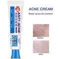 Herbal Acne Face Cream – Pore Minimizing & Skin Brightening Gel Acne Gel Cream Oasis Select 1pc