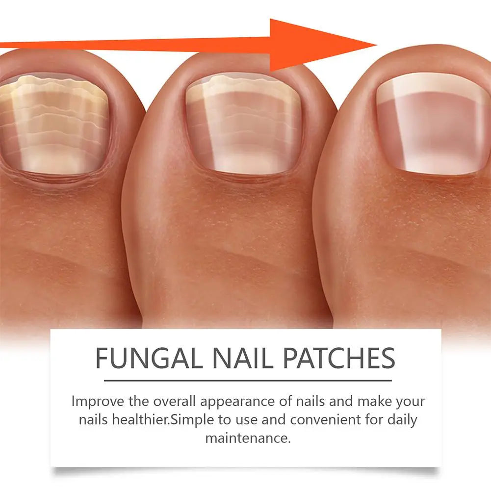 1-3Pcs Fungal Nail Treatment Patch Paronychia Anti-Infection Onychomycosi Removal Grey Nail Repair Correct Ingrown Nail Sticker Oasis Select