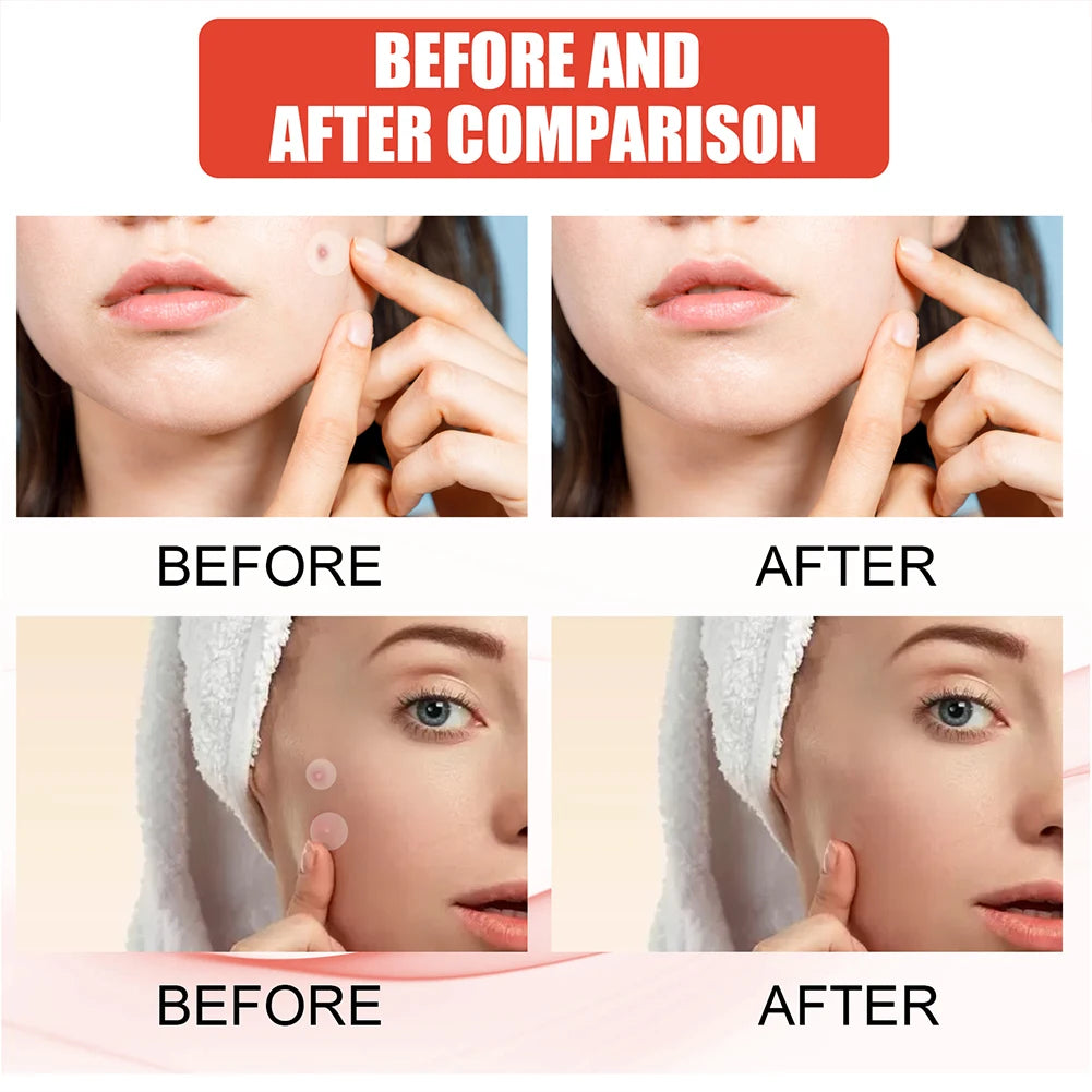 144pcs/set Face Skin Care Acne Pimple Patch 2 Sizes Invisible Professional Healing Absorbing Spot Sticker Covering for Men Women Oasis Select