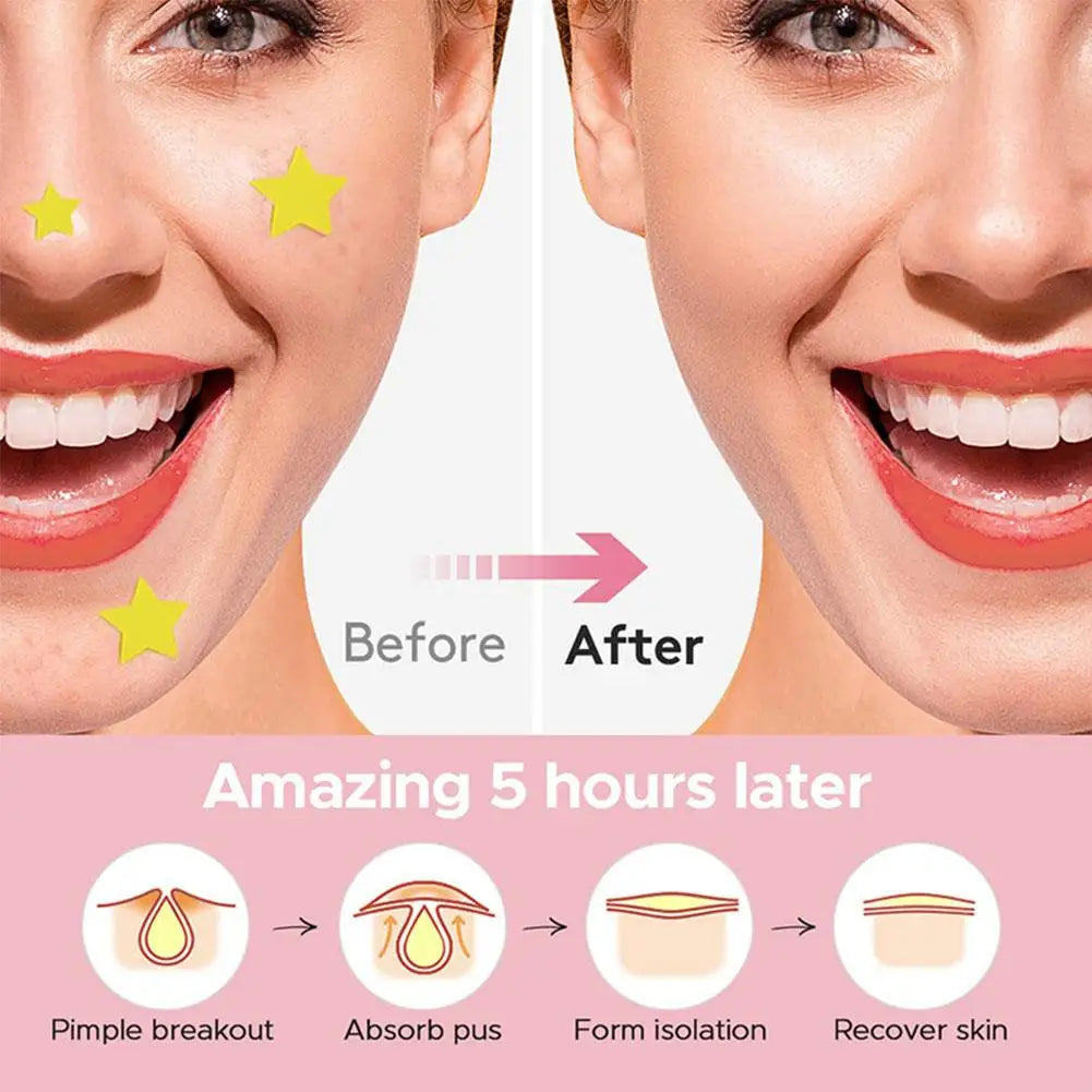 600 Counts Colorful Star Spot Acne/Pimple Patch For Face, Hydrocolloid Cute Star Shaped Acne Patch Invisible Zit Cover Stickers Oasis Select