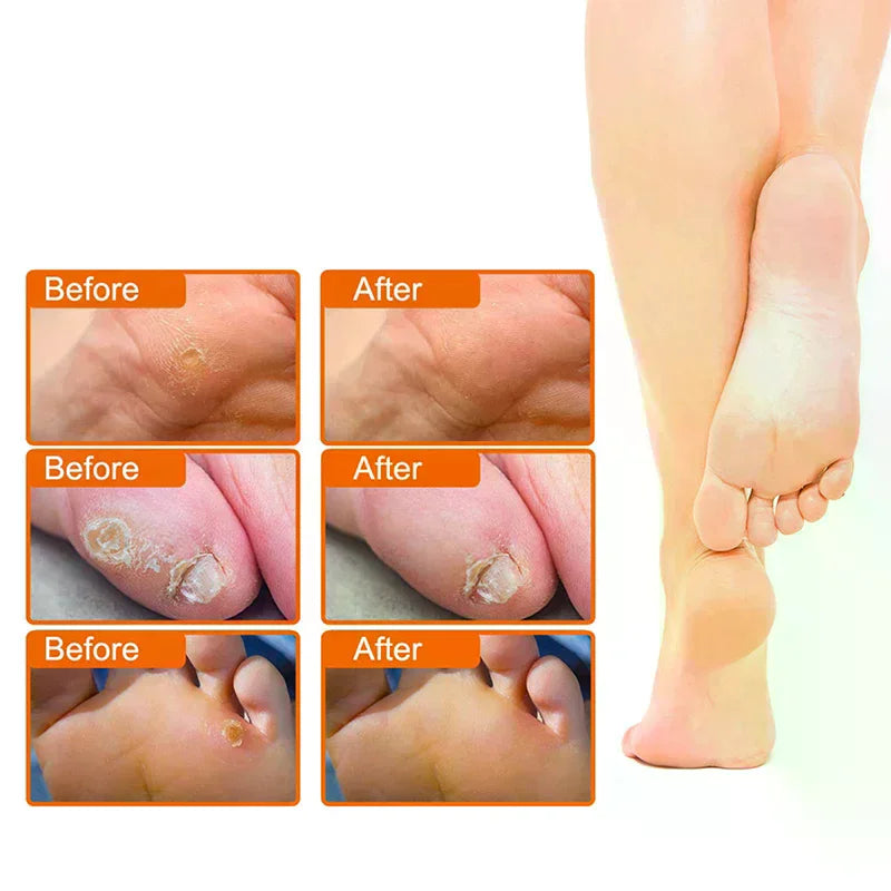 36PCS Toe And Foot Protectors Pads Corns Callus Feet Sore Shoes Sticker Self Adhesive Cushions Soft Heel Pad Foam Foot Paste Oasis Select