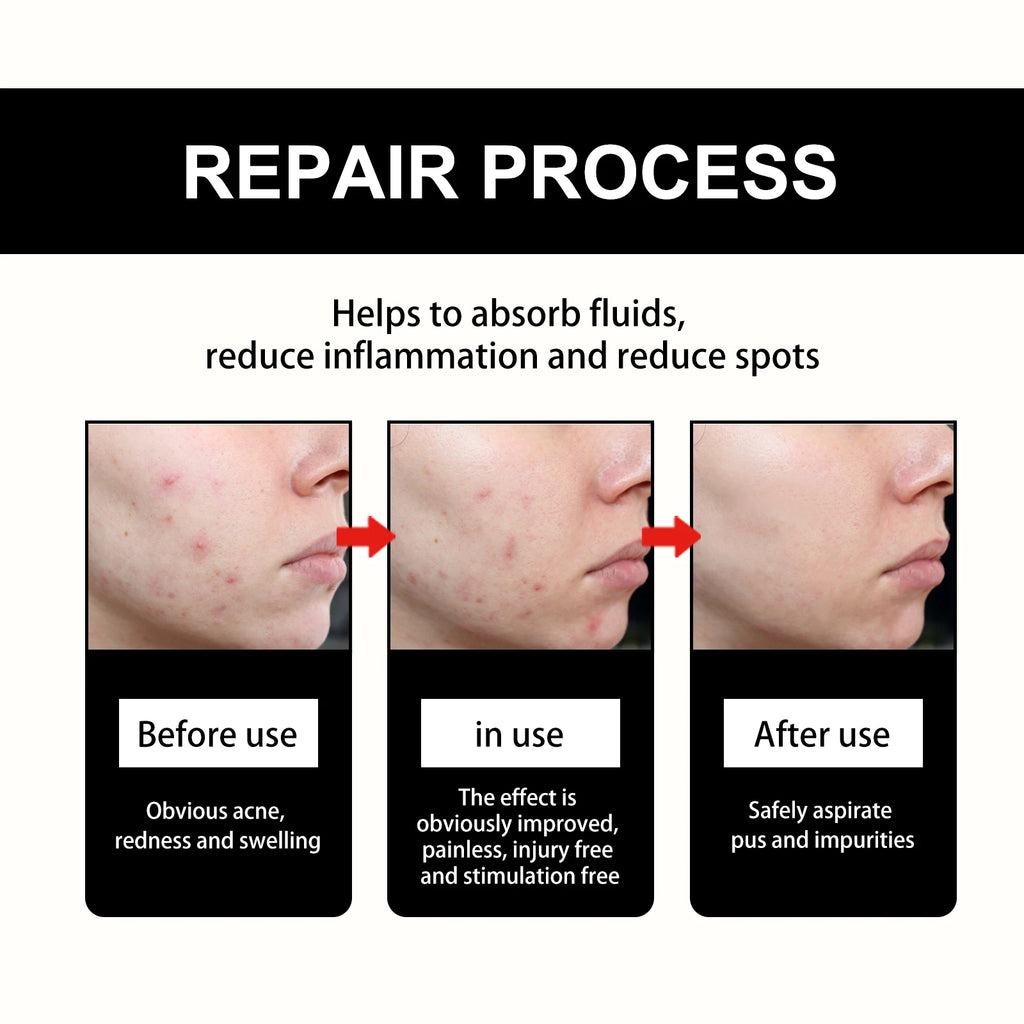 Hoygi Black Acne Patches – Spots, Blackheads & Blemish Care