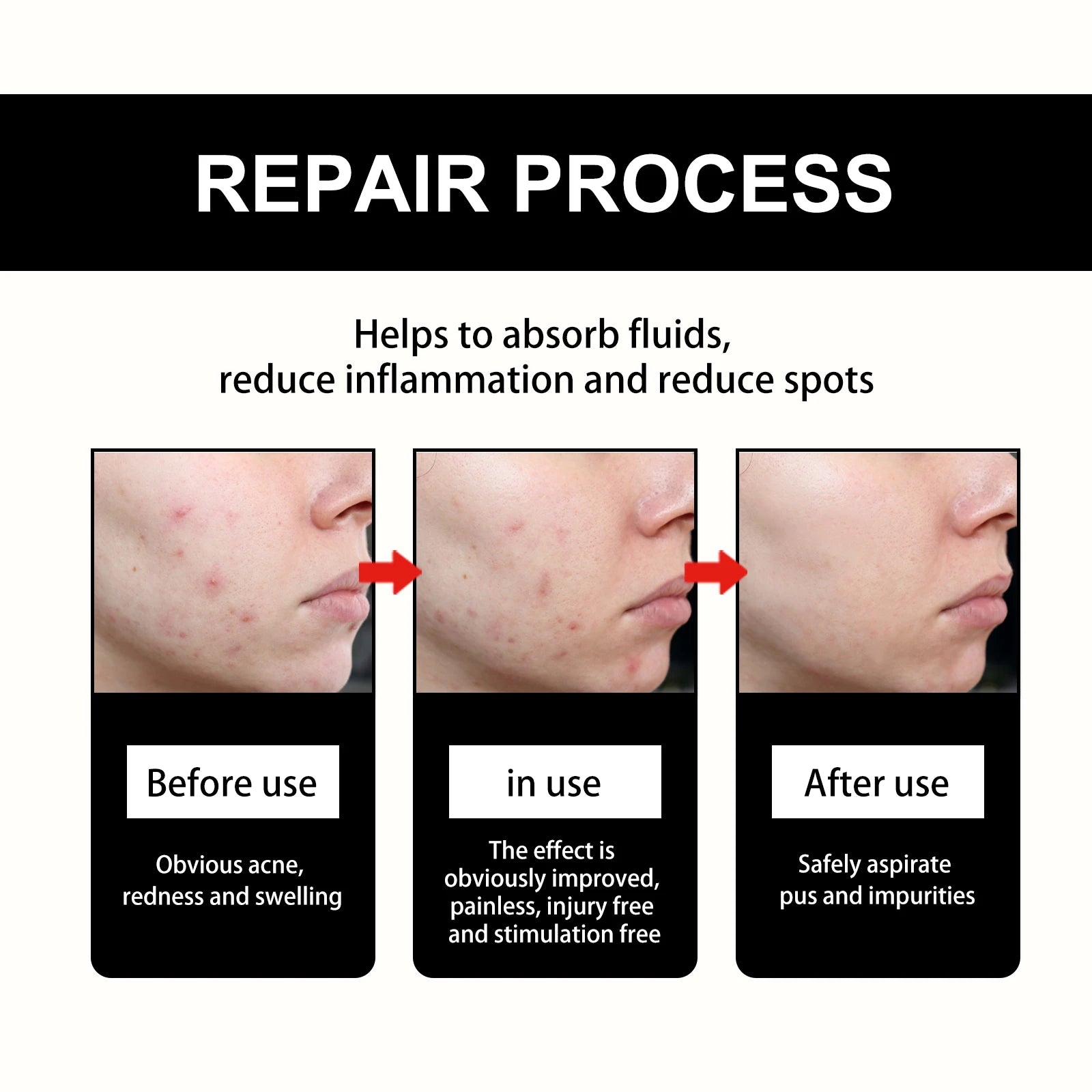 Hoygi Black Acne Patches – Spots, Blackheads & Blemish Care