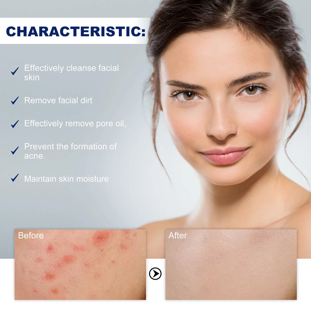 Hoygi Anti-Acne Facial Cleanser – Oil Control & Pore Minimizer