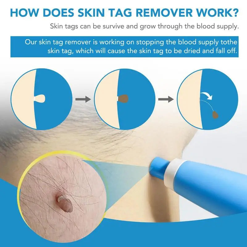 Skin Tag Removal Tool Face Beauty Accessories Skin Tag Removal Device Multipurpose Supplies for Face Neck Chin Back Oasis Select
