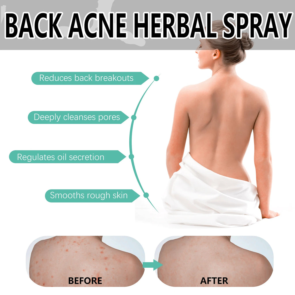 Herbal Acne Remover Spray Back Shoulder Pimple Treatment Blackhead Anti Mites Oil Control Repair Smooth Skin Care Beauty Health Oasis Select