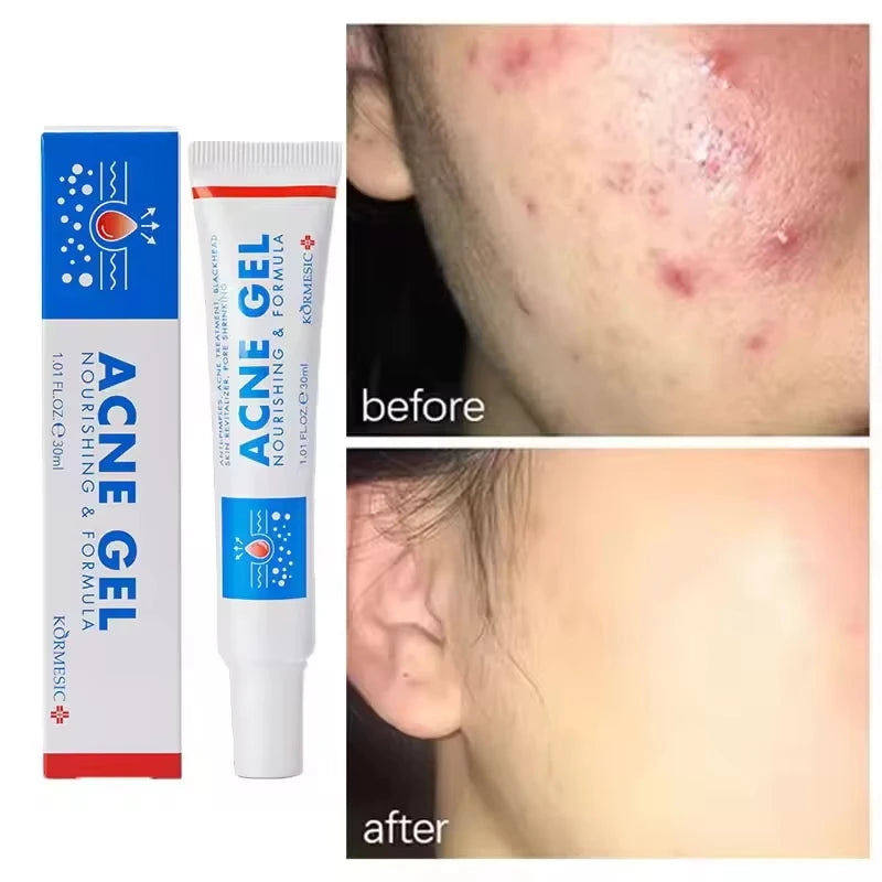 SADOER Salicylic Acid Acne Cream – Oil Control & Pore Minimizer Acne Face Cream Oasis Select