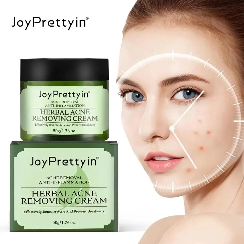 JoyPretty Herbal Acne Face Cream – Oil Control & Marks Removal Herbal Acne Cream Oasis Select