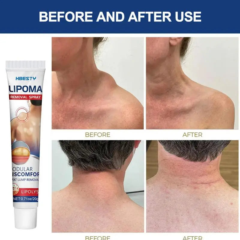 Lipoma Removal Cream Relief Swelling Fat Elimination Cream 20g Remove Subcutaneous Lump Herbal Extract Care Fat Bulges Lump Oasis Select