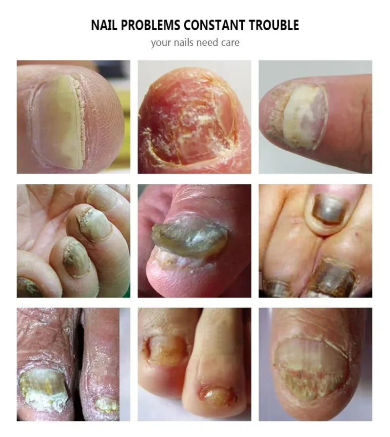 Nail Repair Serum – Foot & Toe Nail Restoration Oil Nail Repair Serum Oasis Select