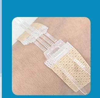Zipper Wound Closure Strips | No-Suture Fast Closure Patch