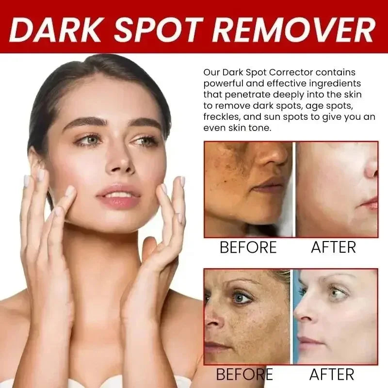 Powerful Spot-Removing Whiten Cream Brighten Skin Fast Eliminates Melanin Pigmentation Melasma Dark Spots Korean Face Skin Care Oasis Select