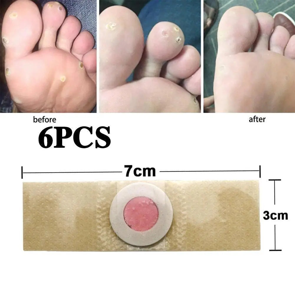 6-Pack Corn & Callus Remover Pads – Self-Stick Foot Patches Foot Corn Remover Oasis Select