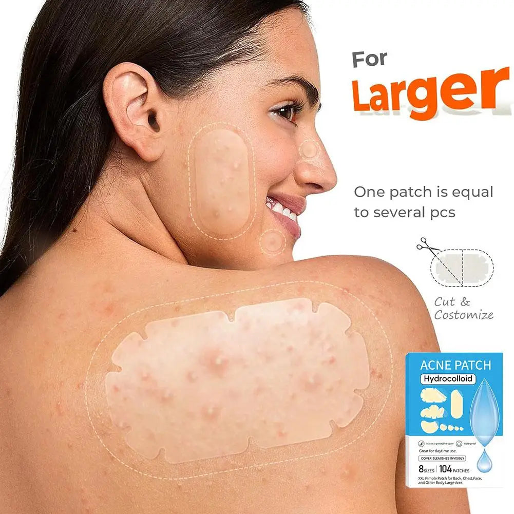 Large Hydrocolloid Pimple Patches Bulk – 5 Sizes Acne Patches Hydrocolloid Acne Patches Oasis Select