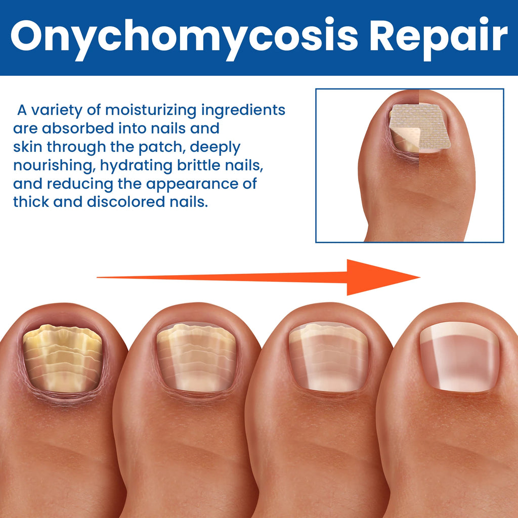 Nail Repair Patches Toenail Fungus Patch Sticky Toenail Care Nail Ingrown Correction Sticker Paronychia Nail Treatment Patch Oasis Select