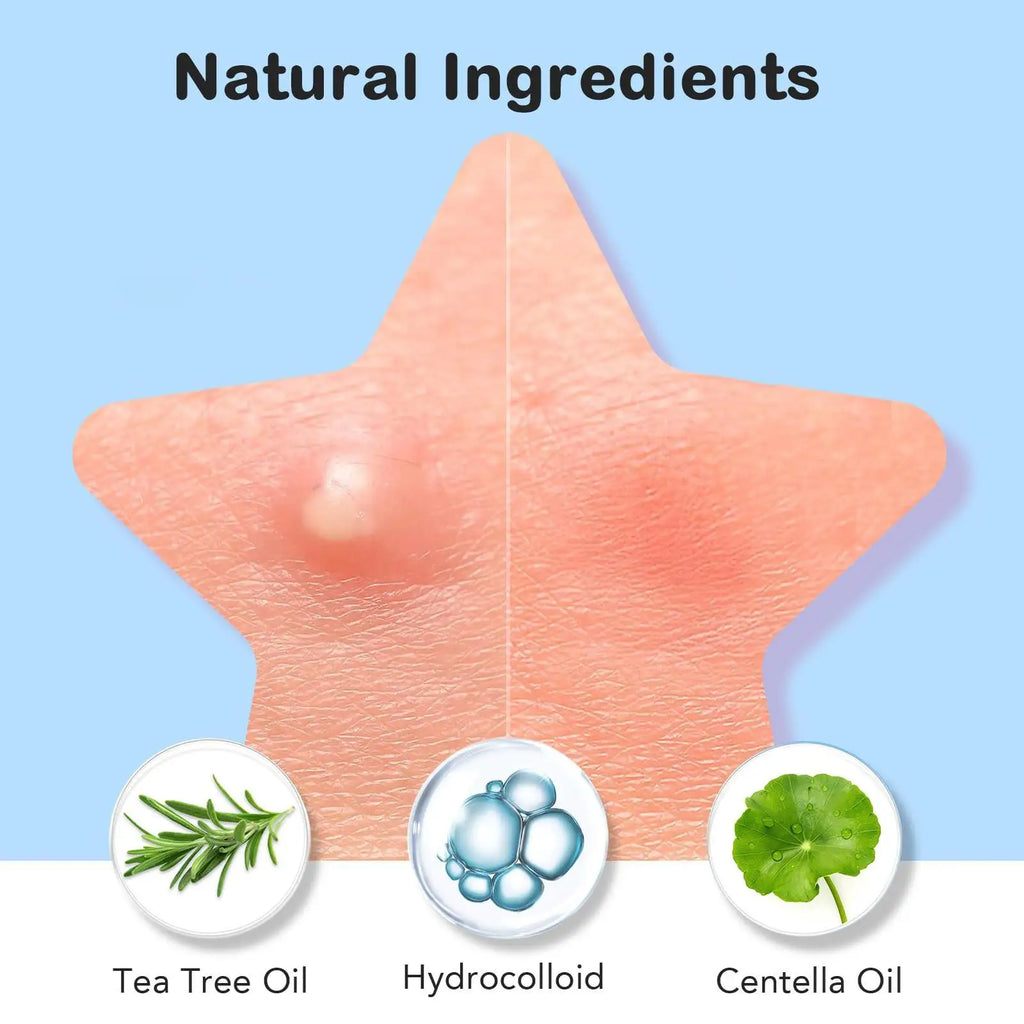 200 Pieces of Facial Pimple Patches, Hydrocolloid Acne Patches with Tea Tree Oil, Salicylic Acid and Mica Oil, Suitable for All Oasis Select