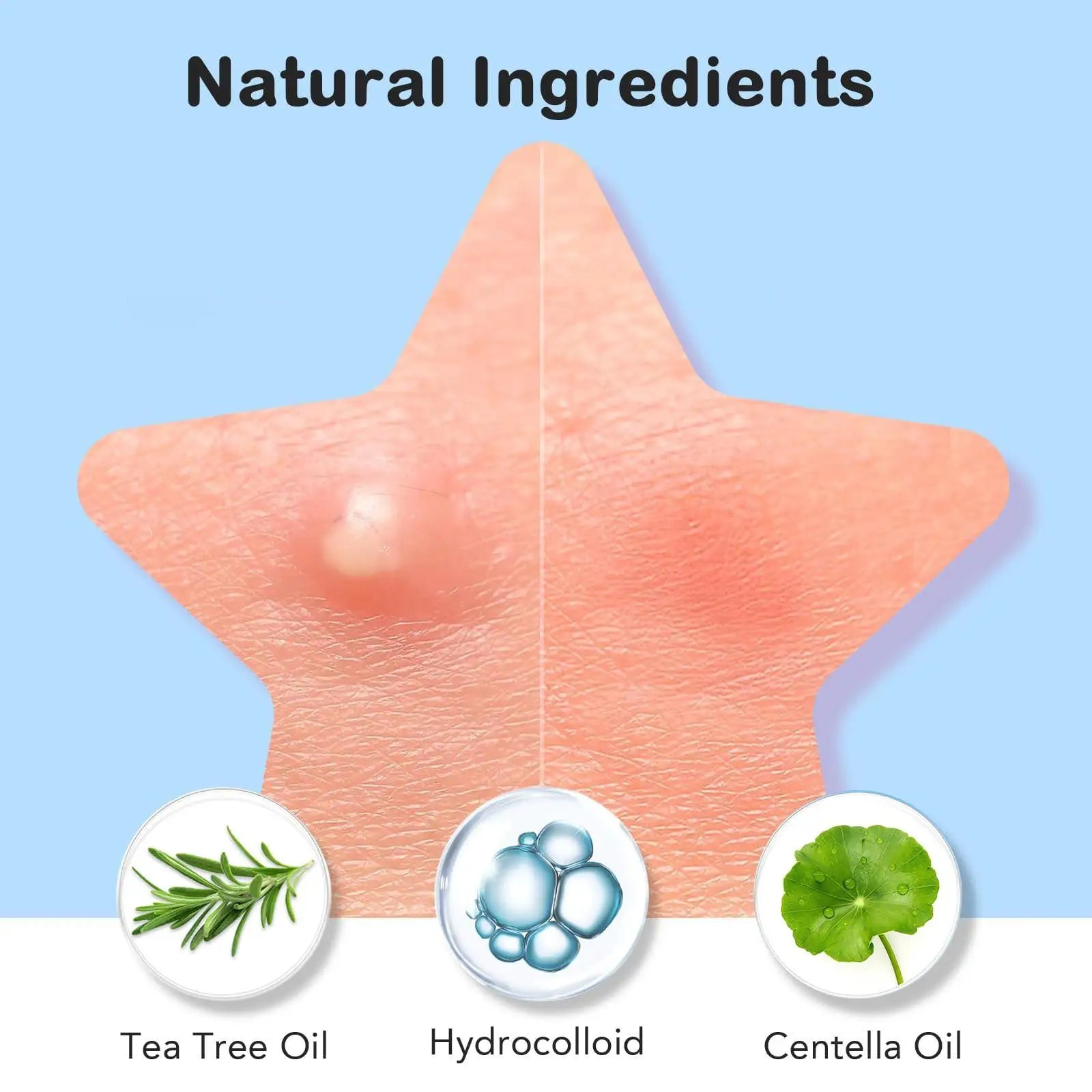 Star Acne Patches 240/480/720 Pieces, High-Quality Emergency Kit, Invisible Hydrogel Absorbs Pus Quickly, Reduces Swelling, Cute Oasis Select
