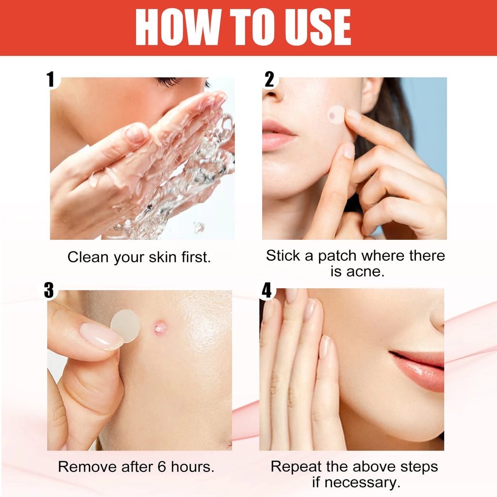Hydrocolloid Acne Patches 144pc – 2 Sizes, Invisible & Clear Acne Patch Oasis Select
