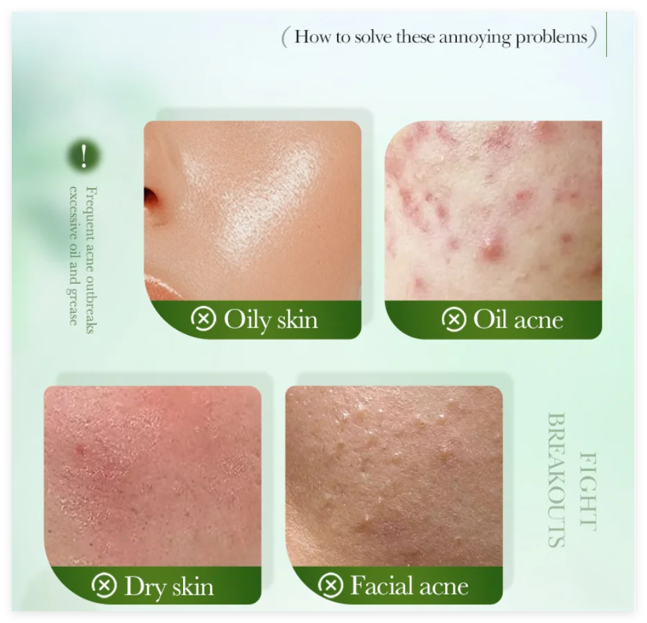 SADOER Salicylic Acid Face Cream – Oil Control & Clear Pores Acne Face Cream Oasis Select
