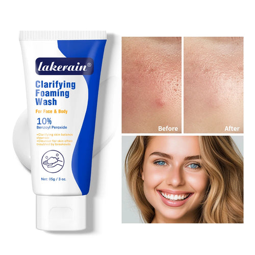 Acne Foaming Wash Benzoyl Peroxide 10% Maximum Antimicrobia Moisturizers reduces redness For Face & Body Skin Care Face Wash Oasis Select 1pc