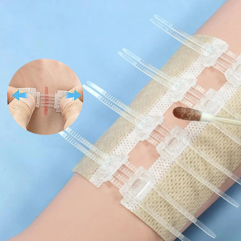 Zipper Wound Closure Strips | No-Suture Fast Closure Patch