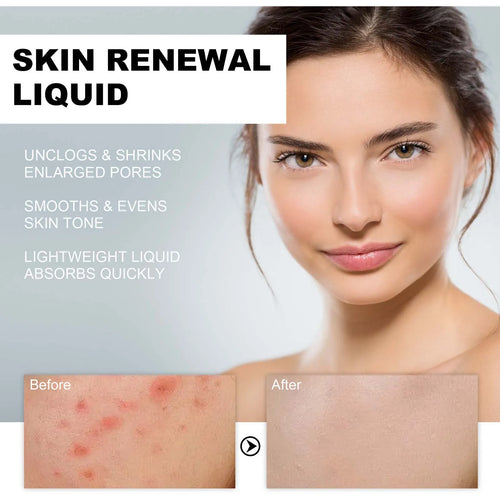 2% BHA Salicylic Acid Serum – Acne, Pores & Dark Spots | 118ml BHA Acne Serum Oasis Select