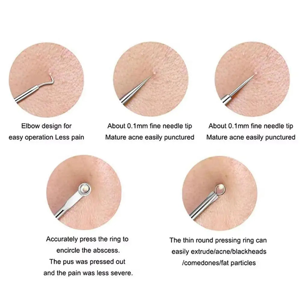 4-Piece Blackhead Remover Tool Set – Stainless Steel Acne Kit Blackhead Remover Kit Oasis Select