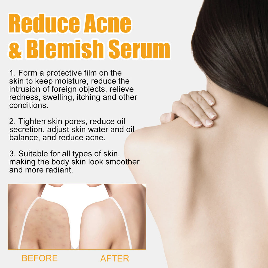 Acn-e Treatm-ent Serum Body Fade Sp-ots Relieve Pigm-entation Moisturizing Smooth Facial Skin Buttock Ac-ne Remover Essence 50ml Oasis Select
