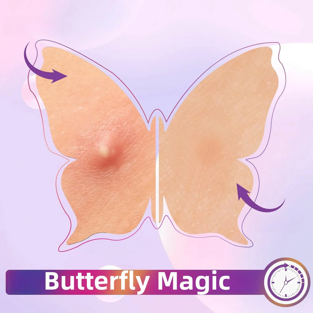Five kinds of color butterfly/love acne patches, 120 pieces/box, deep cleaning acne patches, for men and women Oasis Select