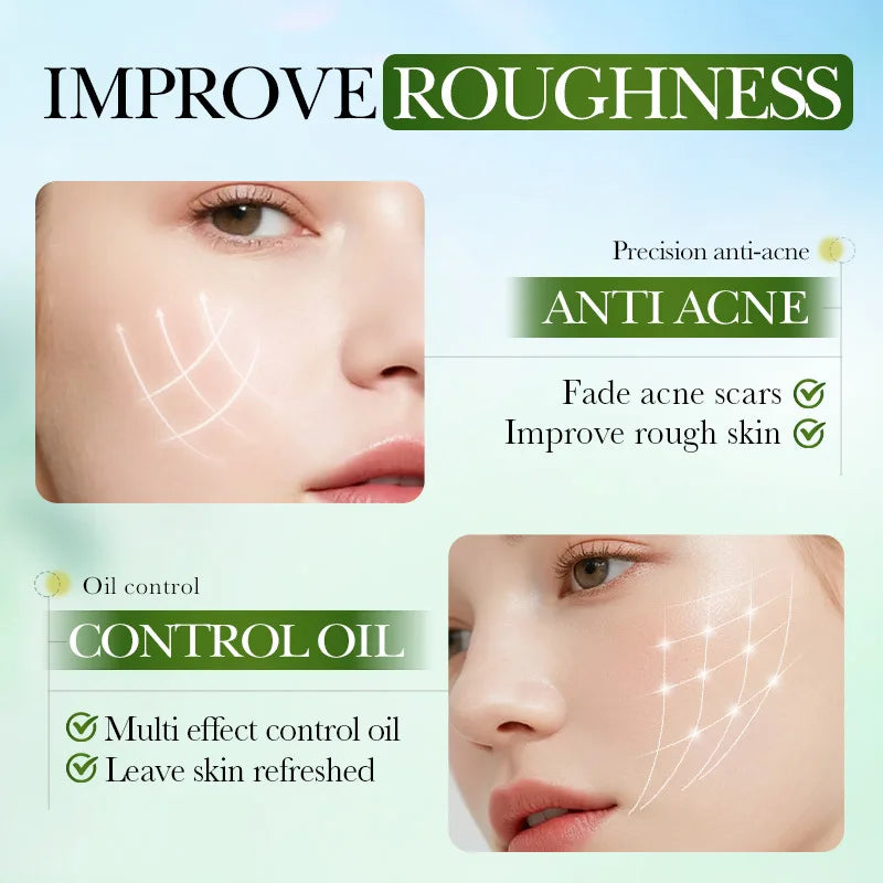 SADOER Salicylic Acid Face Cream – Oil Control & Clear Pores Acne Face Cream Oasis Select