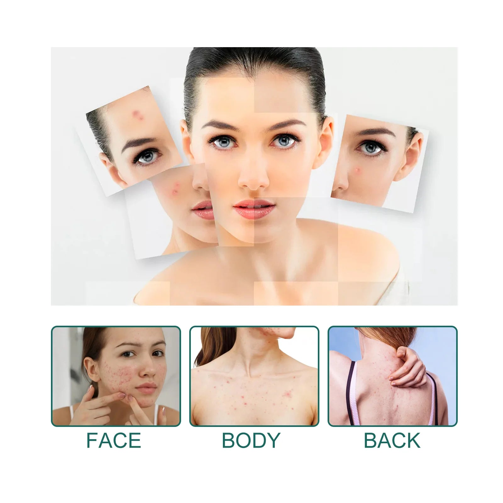 Star-Shaped Acne Pimple Patches – Soothing Blemish Treatment