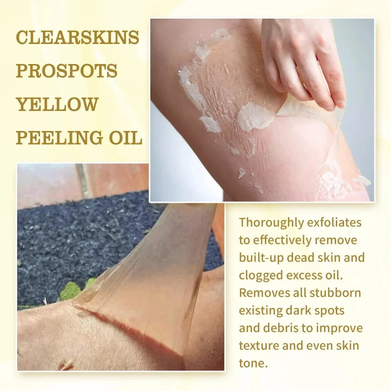 Strong Yellow Peeling Oil Bleach Dark Skin Whiten Lotion Lighten Body Elbow Knee Hand Exfoliate Dead Skin Nourish Even Skin Tone Oasis Select
