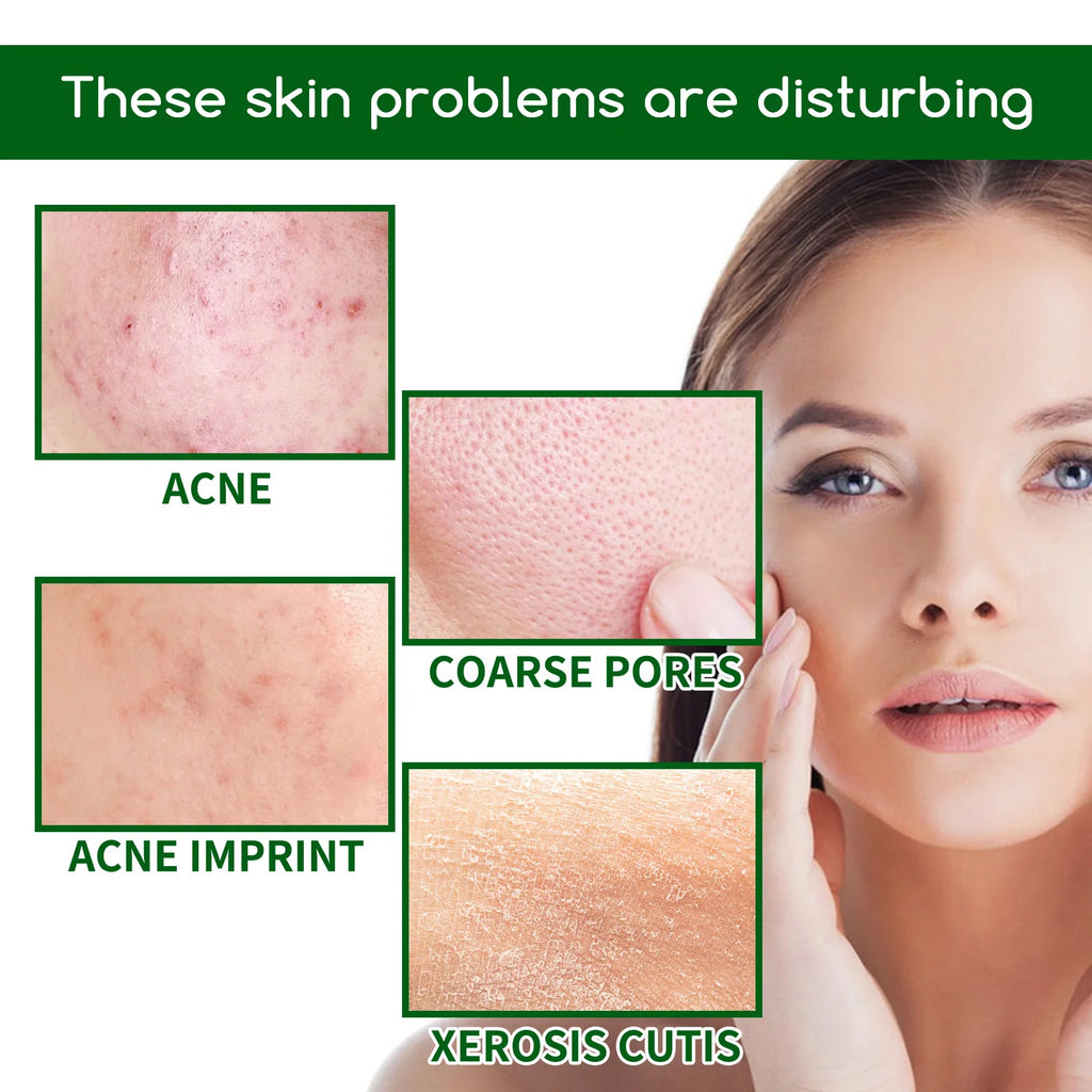 Salicylic Acid Anti Acn-e Face Serum Hydrating Fader Acne Mark Pimple Blackhead Removal Shrink Pores Oil Control Facial Essence Oasis Select