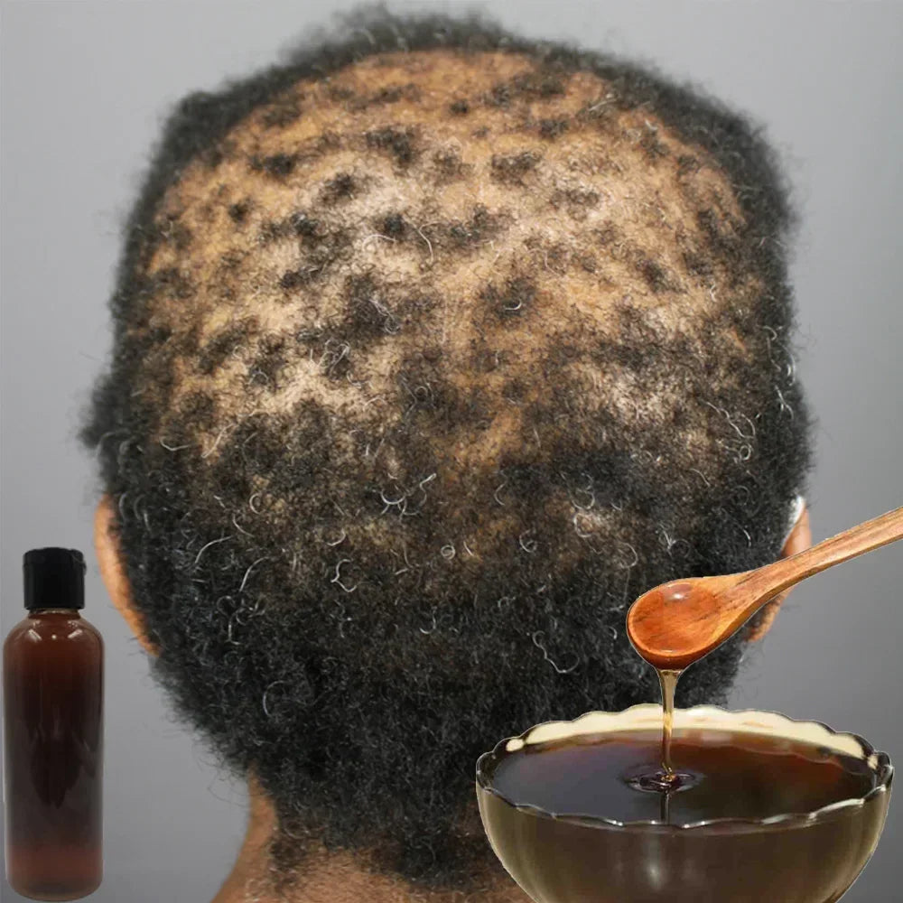 Africa Women Traction Alopecia Treatment Hair Loss Treatment Get Rid of Wigs Hair Growth Product for Men Shampoo 300ml Hair Care Oasis Select