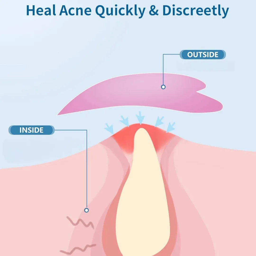 Rose red love design hydrogel acne patch, 24/144 pieces per box, waterproof, breathable, suitable for use day and night Oasis Select