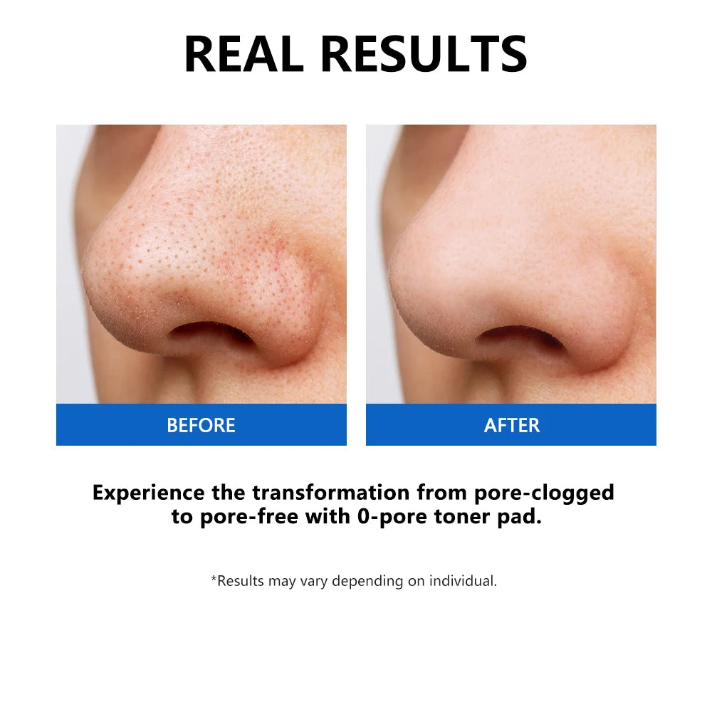 Zero Pore Toner Pads – Oil Control, Exfoliate & Refine Pores