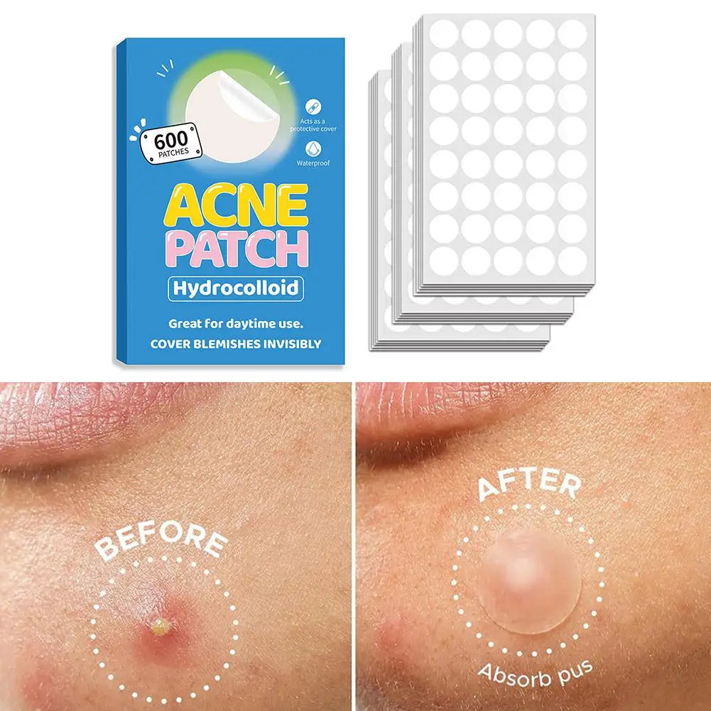 40/360/600/720 Counts Invisible Hydrocolloid Patches For Covering Zits And Blemishes, Acne Pimple Patches For Face Spot Stickers Oasis Select