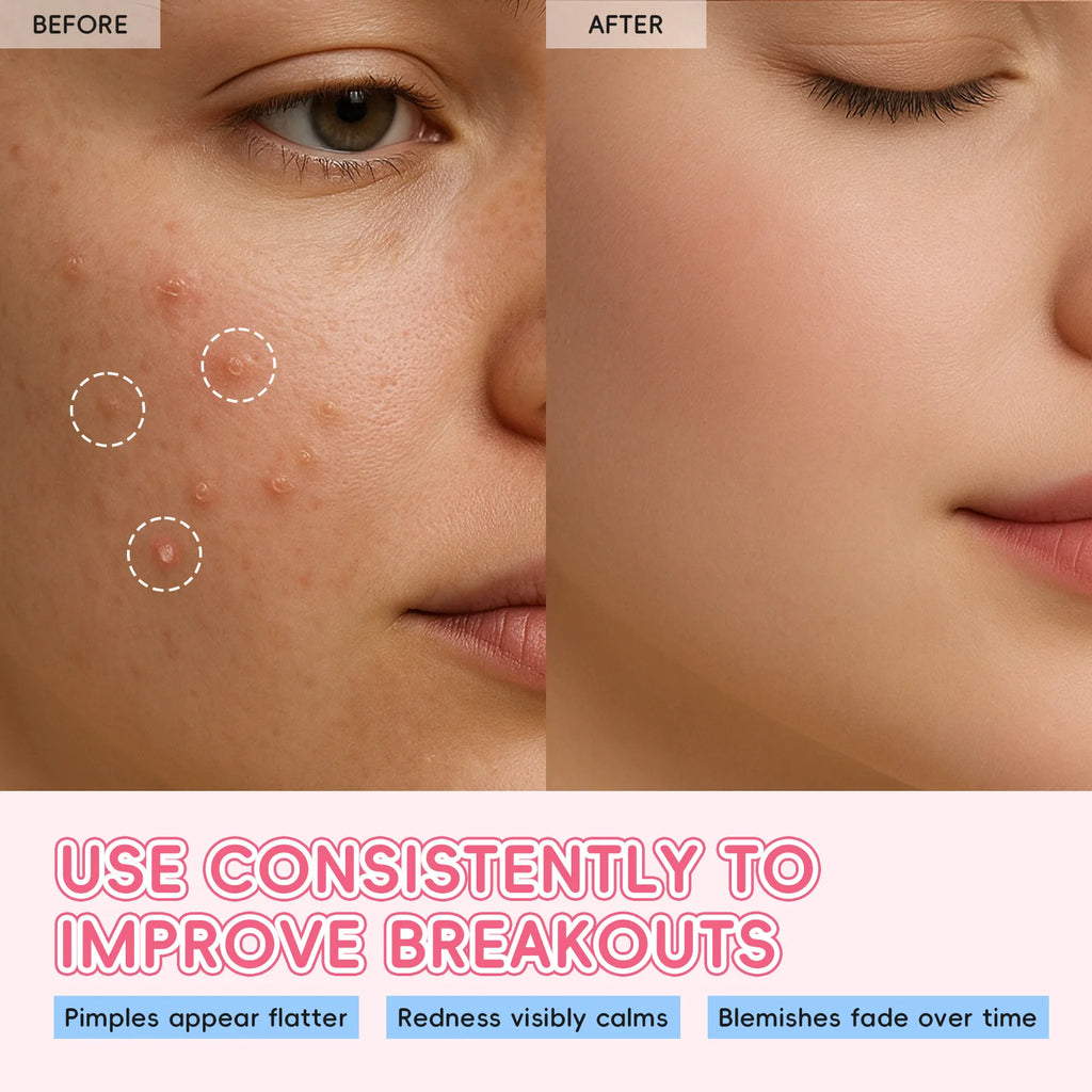 Laikou Sakura Acne Patches – Pimple Concealer Dots 24pc Acne Patches Oasis Select