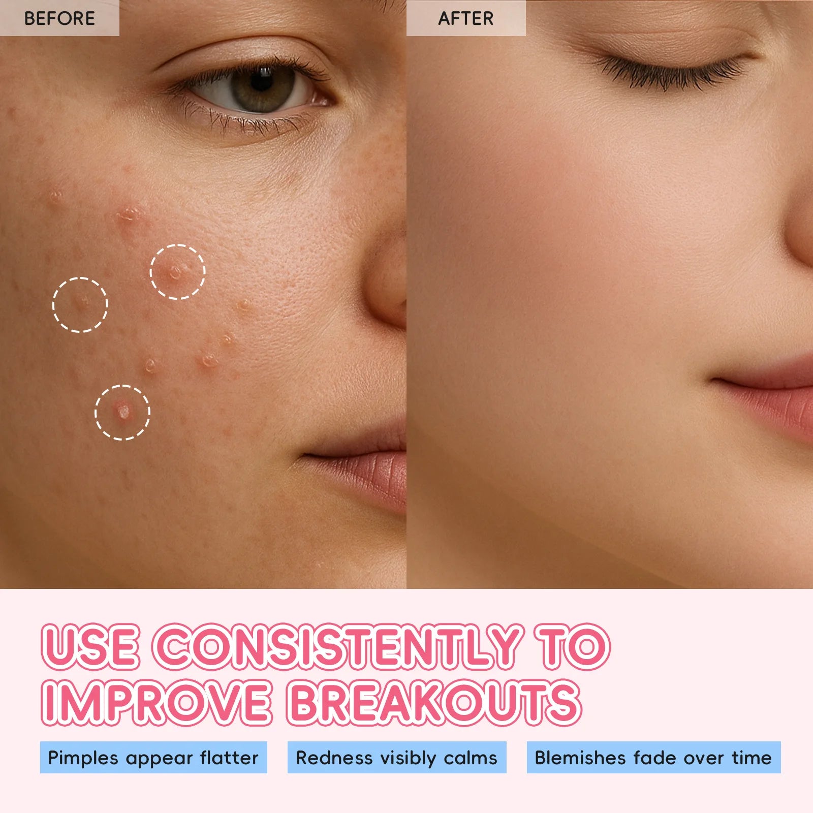Laikou Sakura Patch Acne Patches Pimple Patches Concealer Acne Dots Patches Moisturizes for Covering Zits and Blemishes 24pcs Oasis Select