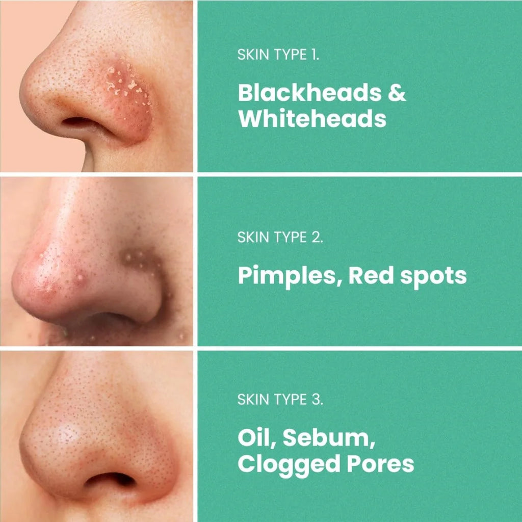 7 pieces/box of hydrogel nose patch - alcohol free, non irritating water-based gel material for deep pore removal Oasis Select