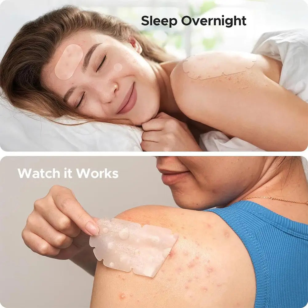 Large Pimple Patches Bulk for Face, 5 Sizes Hydrocolloid Acne Patches for Covering Body, Forehead, Chin Blemishes Zit Breakouts Oasis Select