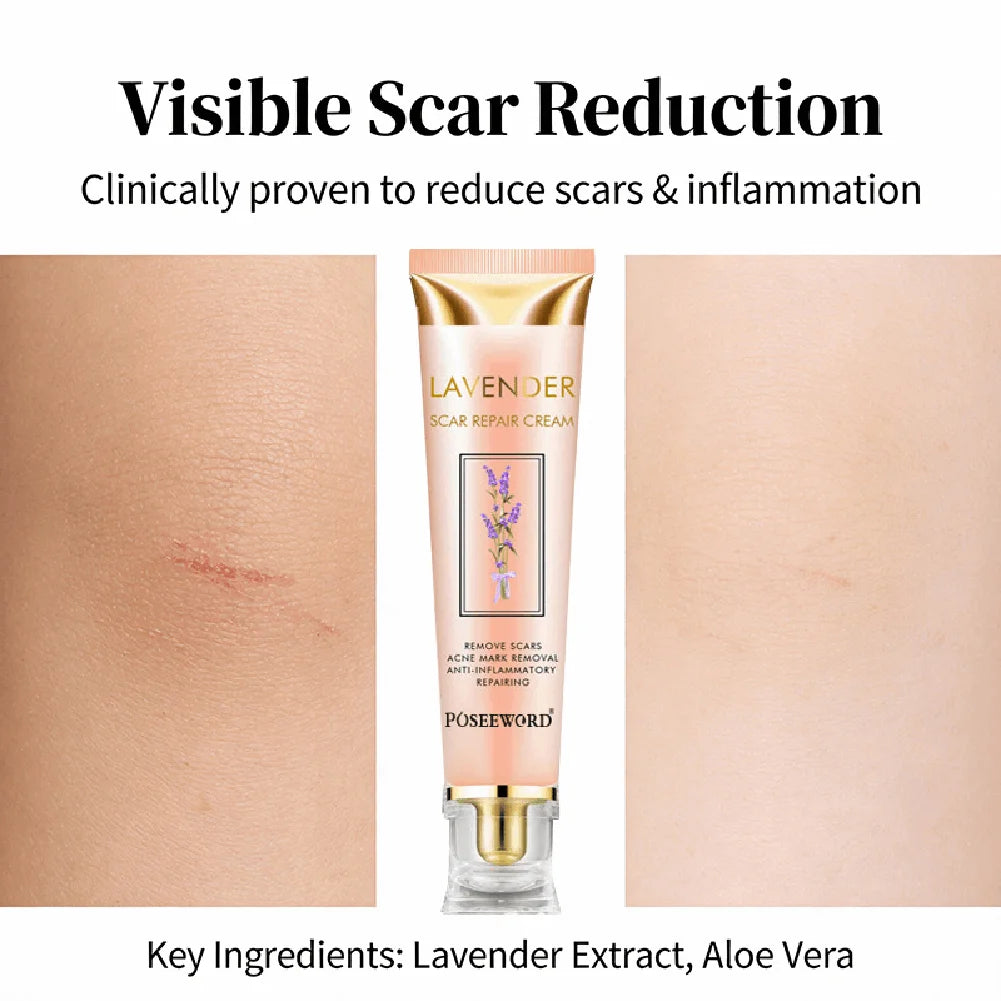 Yoxier Lavender Scar Repair Cream Softens Scar Tissue Removes Acne Marks Smoothes Rough Skin Multi Effect Body Lotion Oasis Select