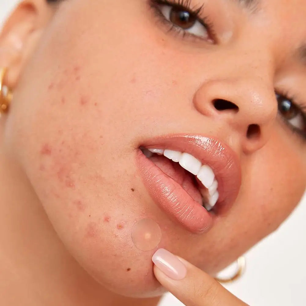 40/360/600/720 Counts Invisible Hydrocolloid Patches For Covering Zits And Blemishes, Acne Pimple Patches For Face Spot Stickers Oasis Select