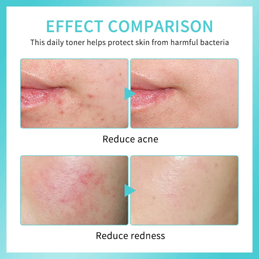 PH Balancing Toner Daily Rescue Facial Spray for Sensitive Skin Hypochlorous Acid Spray Helps Reduce Redness Breakouts Soothing Oasis Select