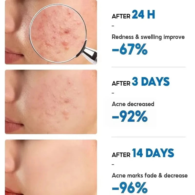Herbal Acne Face Cream – Pore Minimizing & Skin Brightening Gel Acne Gel Cream Oasis Select