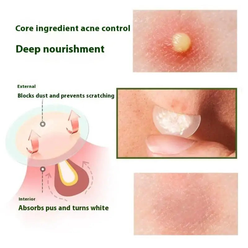 24-720pcs Hydrocolloid Invisible Breathable Pimple Patch Acne Removal Acne Cover Face Spot Pimple Patch Skin Care Stickers Oasis Select