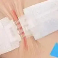 Zipper Wound Closure Strips | No-Suture Fast Closure Patch