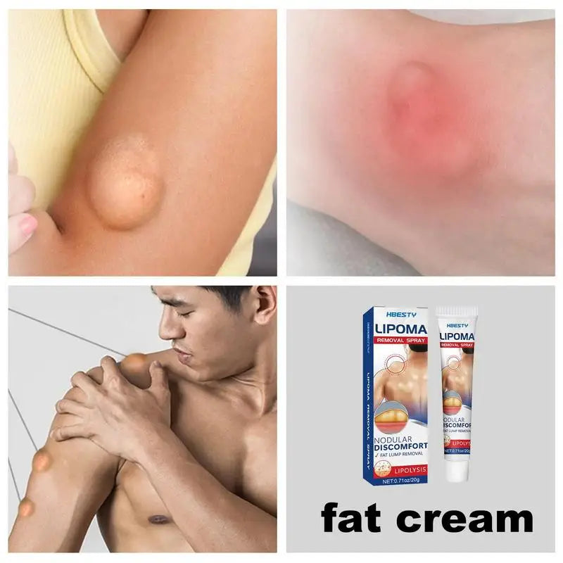 Lipoma Removal Cream Relief Swelling Fat Elimination Cream 20g Remove Subcutaneous Lump Herbal Extract Care Fat Bulges Lump Oasis Select