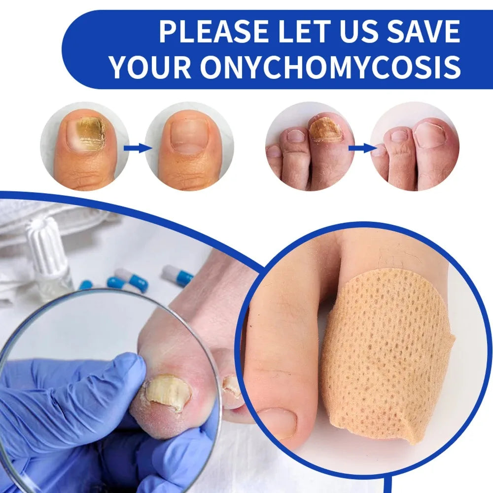 Nail Repair Patches – Ingrown Toenail & Nail Care Stickers Nail Care Patches Oasis Select
